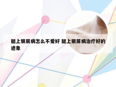 腿上银屑病怎么不爱好 腿上银屑病治疗好的迹象