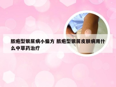 脓疱型银屑病小偏方 脓疱型银屑皮肤病用什么中草药治疗