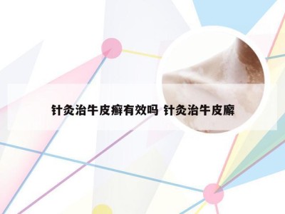 针灸治牛皮癣有效吗 针灸治牛皮廨