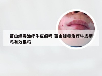 苗山蜂毒治疗牛皮癣吗 苗山蜂毒治疗牛皮癣吗有效果吗
