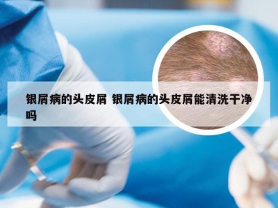 银屑病的头皮屑 银屑病的头皮屑能清洗干净吗