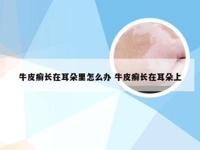 牛皮癣长在耳朵里怎么办 牛皮癣长在耳朵上