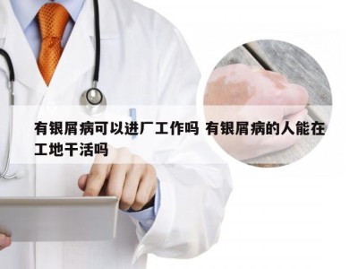 有银屑病可以进厂工作吗 有银屑病的人能在工地干活吗