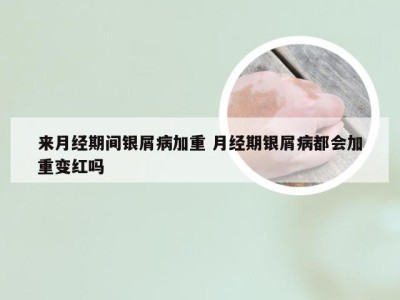 来月经期间银屑病加重 月经期银屑病都会加重变红吗