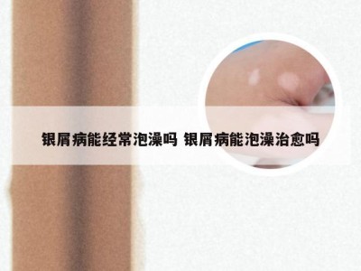 银屑病能经常泡澡吗 银屑病能泡澡治愈吗