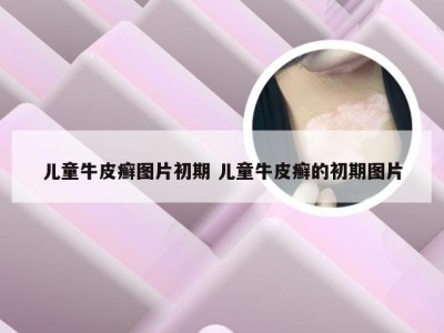 儿童牛皮癣图片初期 儿童牛皮癣的初期图片