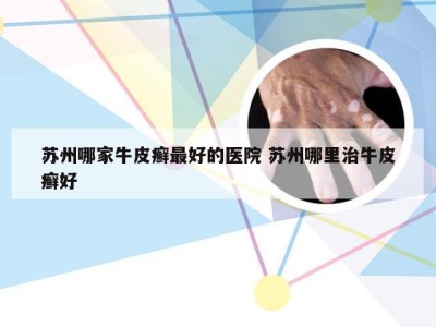 苏州哪家牛皮癣最好的医院 苏州哪里治牛皮癣好