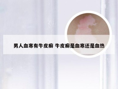 男人血寒有牛皮癣 牛皮癣是血寒还是血热