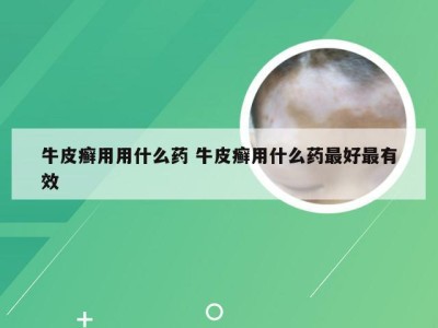 牛皮癣用用什么药 牛皮癣用什么药最好最有效