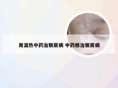 用温热中药治银屑病 中药根治银屑病