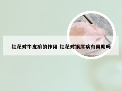 红花对牛皮癣的作用 红花对银屑病有帮助吗