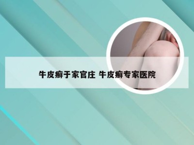 牛皮癣于家官庄 牛皮癣专家医院