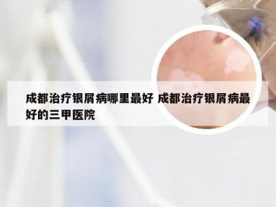 成都治疗银屑病哪里最好 成都治疗银屑病最好的三甲医院