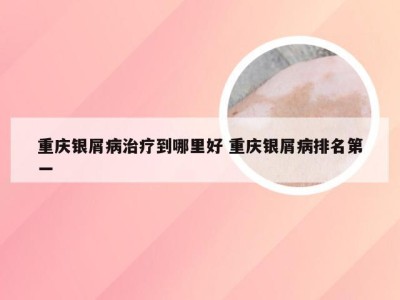 重庆银屑病治疗到哪里好 重庆银屑病排名第一