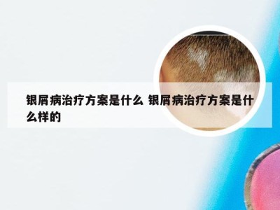 银屑病治疗方案是什么 银屑病治疗方案是什么样的