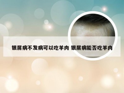 银屑病不发病可以吃羊肉 银屑病能否吃羊肉