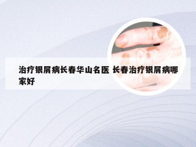 治疗银屑病长春华山名医 长春治疗银屑病哪家好