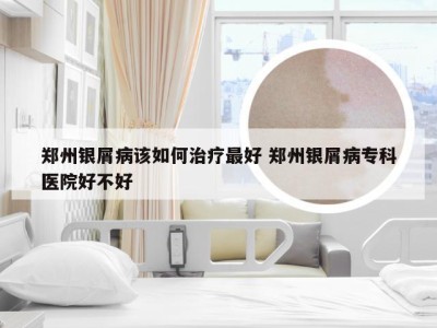 郑州银屑病该如何治疗最好 郑州银屑病专科医院好不好
