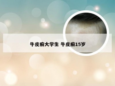 牛皮癣大学生 牛皮癣15岁