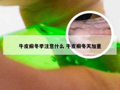 牛皮癣冬季注意什么 牛皮癣冬天加重