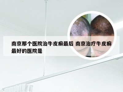 南京那个医院治牛皮癣最后 南京治疗牛皮癣最好的医院是