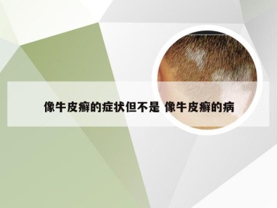 像牛皮癣的症状但不是 像牛皮癣的病