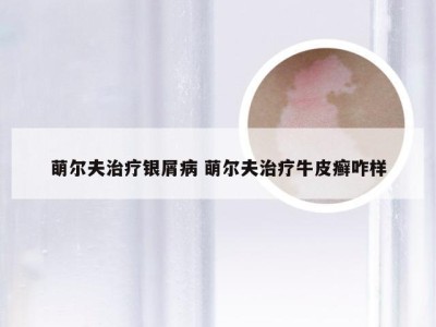 萌尔夫治疗银屑病 萌尔夫治疗牛皮癣咋样