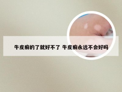 牛皮癣的了就好不了 牛皮癣永远不会好吗