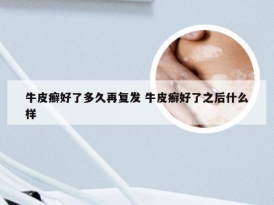 牛皮癣好了多久再复发 牛皮癣好了之后什么样