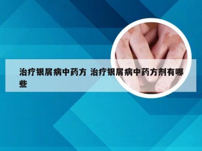 治疗银屑病中药方 治疗银屑病中药方剂有哪些