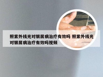 照紫外线光对银屑病治疗有效吗 照紫外线光对银屑病治疗有效吗视频