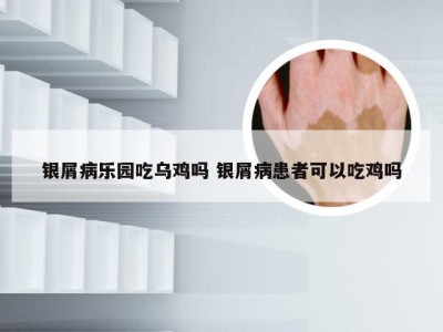 银屑病乐园吃乌鸡吗 银屑病患者可以吃鸡吗