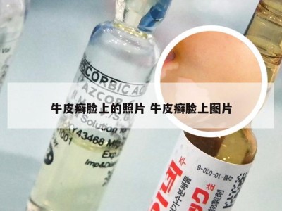 牛皮癣脸上的照片 牛皮癣脸上图片
