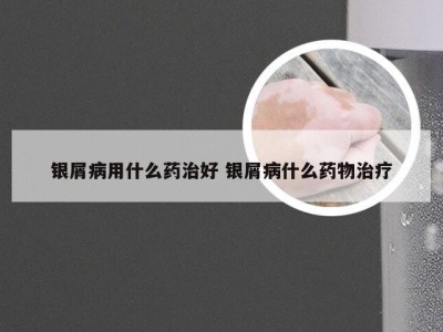 银屑病用什么药治好 银屑病什么药物治疗