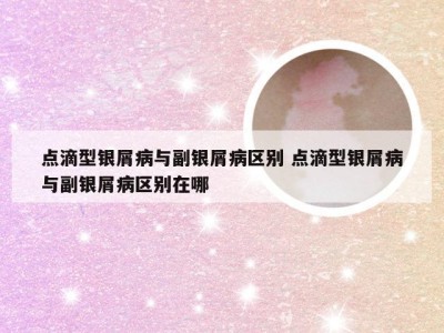 点滴型银屑病与副银屑病区别 点滴型银屑病与副银屑病区别在哪