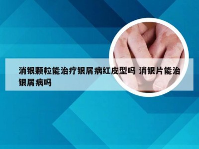 消银颗粒能治疗银屑病红皮型吗 消银片能治银屑病吗