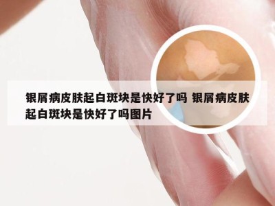 银屑病皮肤起白斑块是快好了吗 银屑病皮肤起白斑块是快好了吗图片