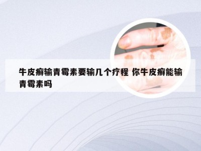 牛皮癣输青霉素要输几个疗程 你牛皮癣能输青霉素吗