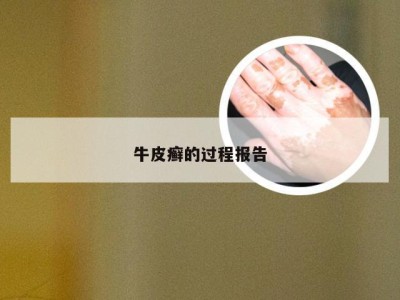 牛皮癣的过程报告