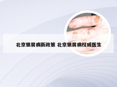 北京银屑病新政策 北京银屑病权威医生