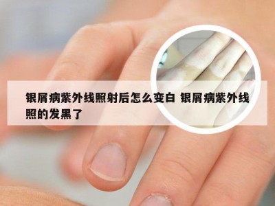 银屑病紫外线照射后怎么变白 银屑病紫外线照的发黑了