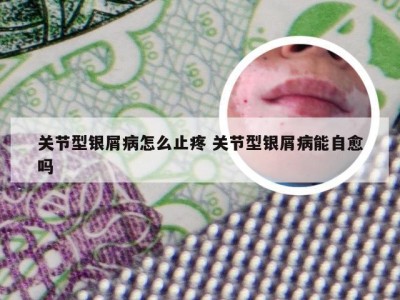 关节型银屑病怎么止疼 关节型银屑病能自愈吗
