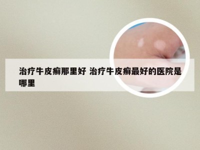 治疗牛皮癣那里好 治疗牛皮癣最好的医院是哪里