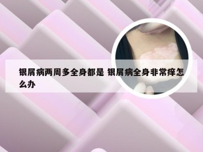 银屑病两周多全身都是 银屑病全身非常痒怎么办