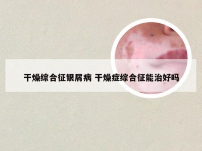 干燥综合征银屑病 干燥症综合征能治好吗