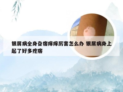 银屑病全身旮瘩痒痒厉害怎么办 银屑病身上起了好多疙瘩