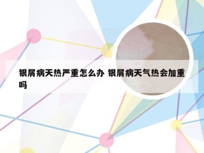 银屑病天热严重怎么办 银屑病天气热会加重吗