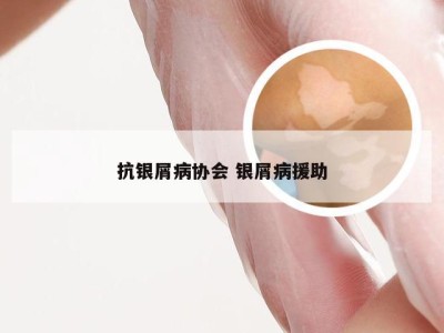 抗银屑病协会 银屑病援助