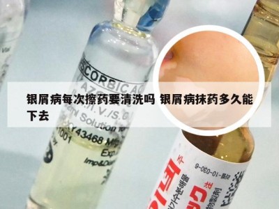银屑病每次擦药要清洗吗 银屑病抹药多久能下去