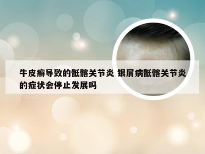牛皮癣导致的骶髂关节炎 银屑病骶髂关节炎的症状会停止发展吗